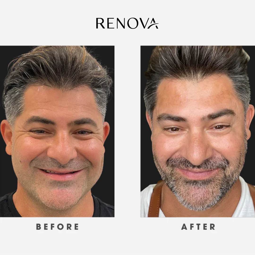 Renova Tallow Reborn™ – Anti-Aging Face Cream